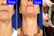 Սուրճը օգտագործեք այսպես և ազատվեք կախված պարանոցից և կնճիռներից