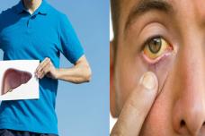 Նշաններ, որ ձեր լյարդը ճարպակալած է․ Ուշադրություն դարձրեք հատկապես 2-րդ կետին