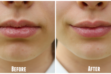 Ինչպե՞ս բուժել ճաքճքած շուրթերը