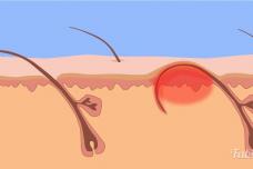 Հոգնե՞լ եք ներաճած մազերից. ինչպես ազատվել խնդրից