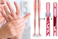 Ինչպես ազատվել ձեռքերի և ոտքերի թմրածությունից