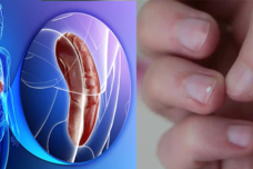 Ի՞նչ հիվանդության նշան կարող է լինել եղունգների վրայի այս հետքը