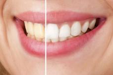 Ինչպես սպիտակեցնել ատամները բնական ճանապարհով