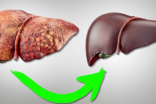 Ինչպես մաքրել լյարդը ճարպակալումից․ Բժշկի այս խորհուրդը կյանքեր է փրկում