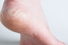 Կրունկների ճաքերի բուժում և ոտքերի մաշկի խնամքի պարզ կանոններ